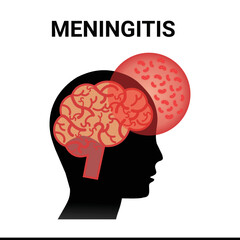 Meningitis inflammation of the brain, vector simple