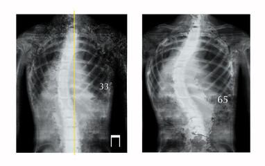 X-rays of human spine showing curvature. Patients suffering from scoliosis