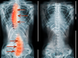 X-rays of human normal and curved spines. Patient suffering from scoliosis - obrazy, fototapety, plakaty
