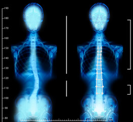X-rays of human normal and curved spines. Patient suffering from scoliosis