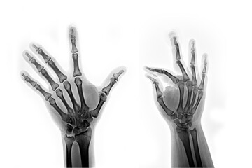 Collection film x-ray finger of fracture 