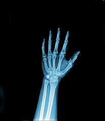 Obraz premium Fracture thumb finger . Film x-ray AP