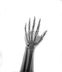 Fracture thumb finger  . Film x-ray AP