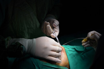 rhinoplasty surgery, defects in the shape of the nose in the female patient. Surgical intervention in plastic surgery rhinoplasty 