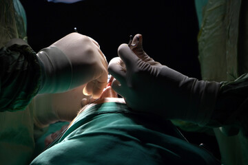 rhinoplasty surgery, defects in the shape of the nose in the female patient. Surgical intervention...