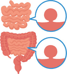 小腸腫瘍のイラスト