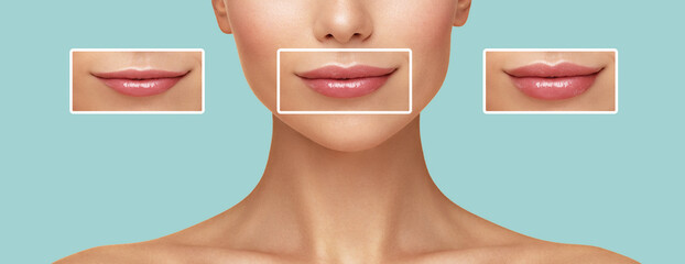  Comparison of a Women lips correction before and after Hyaluronic acid injection.Beauty lip...