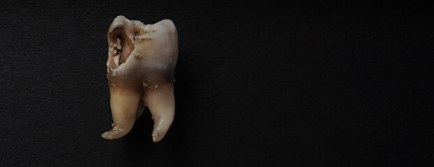 Tooth decay on black background. Macro shot of a decayed teeth till root after extraction of...
