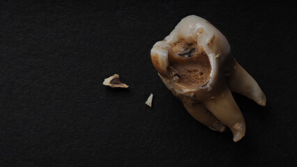 Tooth decay on black background. Macro shot of a decayed teeth till root after extraction of...