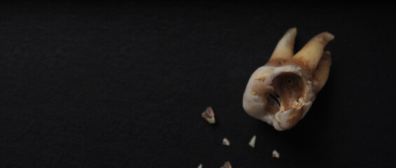 Tooth decay on black background. Macro shot of a decayed teeth till root after extraction of dentist. Real tooth anatomy due lack of care. Top view of caries teeth texture on black paper. Dental care.