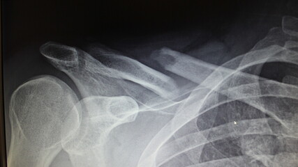 X ray of a broken collarbone/clavicle