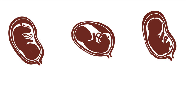 Different baby position during pregnancy. Anterior, transverse, breech. Design for health care, education