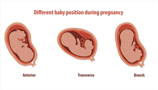 Different baby position during pregnancy. Anterior, transverse, breech. Design for health care, education