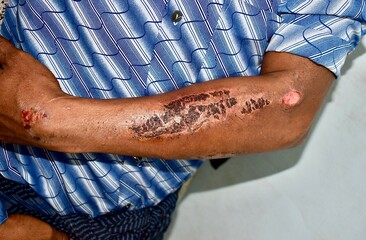 Abrasions healed with scabs at the forearm of Asian patient.