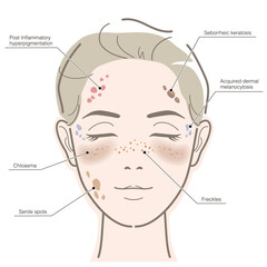 Diagram of women's facial age spots. Vector illustration isolated on white background.
