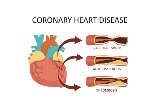 Coronary heart disease. Heart attack - atherosclerosis, thrombus, spasm,