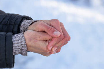 Women's frozen hands in the cold.Women's hands with dry skin and red fingers in the cold in...