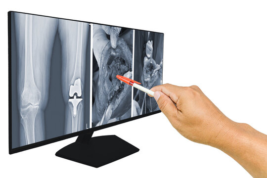 The doctor reported  x-ray knee operation Case severe bone loss varus knee s/p Left Total Knee Arthroplasty(TKA0 with bone graft reconstruction.. Medical education concept.