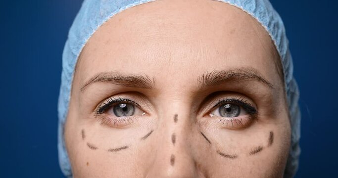 woman is ready for face plastic surgery. facelift procedure