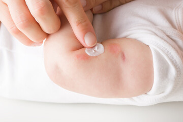 Young adult mother finger applying white medical ointment on newborn arm. Red rash on skin. Allergy from milk formula or mother milk. Care about baby body. Closeup. Side view.