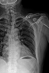 Film x-ray clavicle  AP show fracture clavicle bone