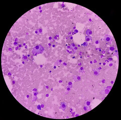 Bone marrow study. Plasma cell dyscrasia or Multiple myeloma. Present marrow nucleated cells,...