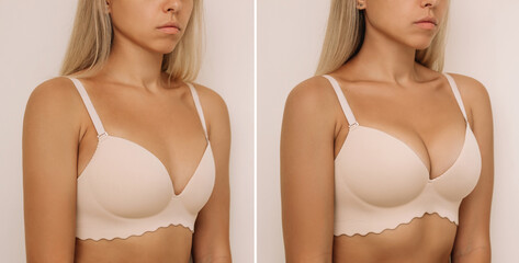 Young tanned blonde woman in bra before and after breast augmentation with silicone implants. The...