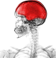 X-ray skull lateral view  show head injury 