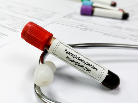 Blood sample for Thyroid stimulating Immunoglobulin test. Throtropin binding inhibitory Immunoglobulin. Anti TSHR Ab.