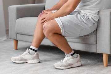 Man with bruises on his legs sitting on sofa at home