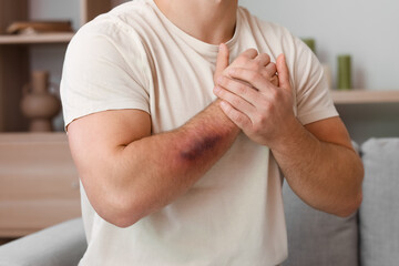 Man with bruises on his arm at home