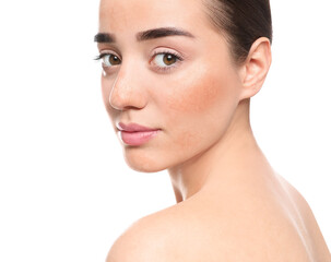 Young woman with dry skin on white background