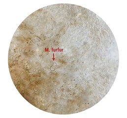 Microscopic view of Skin scraping fungus showing fungi Malassezia furfur or M. furfur. They are naturally found on the skin surfaces and are also associated with dandruff