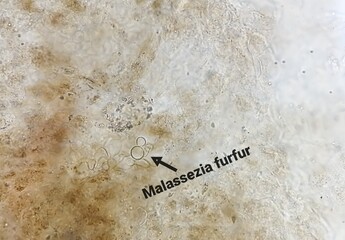 Microscopic view of Skin scraping fungus showing fungi Malassezia furfur or M. furfur. They are naturally found on the skin surfaces and are also associated with dandruff