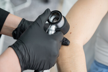 A dermatologist examines a patient's mole through a dermatoscope. 