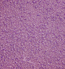 Acute leukemia (Probably ALL). Anisocytic anisochromia, increased lymphocytes, reduced platelets. Acute lymphoblastic leukemia.