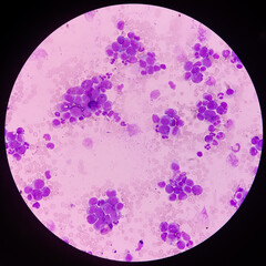 Chronic myeloid leukemia or CML(chronic phase) with microcytic hypochromic anemia. Type of blood...