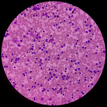 Acute leukemia (Probably ALL). Anisocytic anisochromia, increased lymphocytes, reduced platelets. Acute lymphoblastic leukemia.