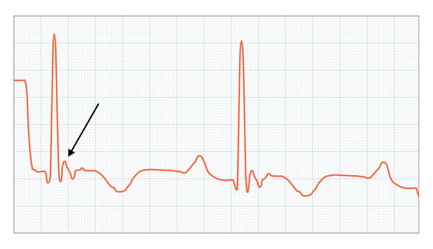 Epsilon Wave - ECG, Posterior myocardial, ventricular, Infiltrative disease test chart