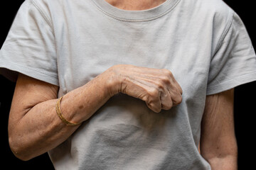 Volkmann’s contracture in Southeast Asian old woman.