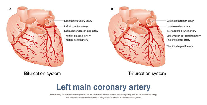 The left main coronary artery can be divided into the left anterior  descending artery and the left circumflex artery, and sometimes the  intermediate branch artery. Иллюстрация Stock | Adobe Stock