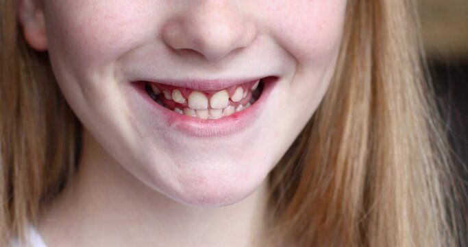 The girl smiles and shows her teeth. Baby teeth in a child