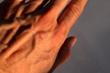 Small injury on a mans hand. Burned mark from a hot oven. Stockholm, Sweden.