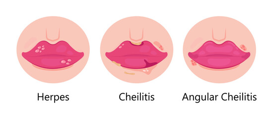 Herpes lips vector. Simplex virus infection causes recurring episodes of small, painful, fluid-filled blisters on skin, mouth, lips.