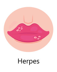 Herpes lips vector. Simplex virus infection causes recurring episodes of small, painful, fluid-filled blisters on skin, mouth, lips.