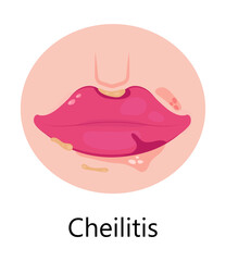 Herpes lips vector. Simplex virus infection causes recurring episodes of small, painful, fluid-filled blisters on skin, mouth, lips.