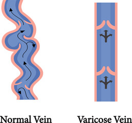 Fototapeta premium Varicose veins. Image of healthy and diseased legs. A longitudinal section of a vein with a description of the main parts. Vector illustration in flat style 