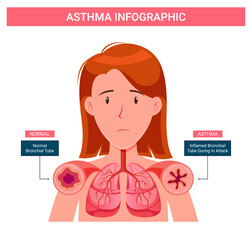 Asthma infographic, human asthma vector concept