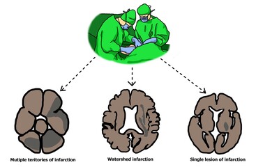 The different patterns of ischemic stroke in perioperative stroke complications.