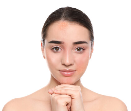 Young woman with dry skin on white background